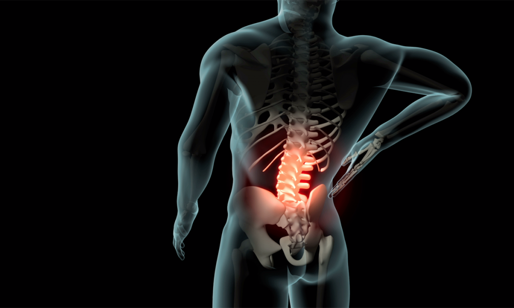 esqueleto con lumbago crónico