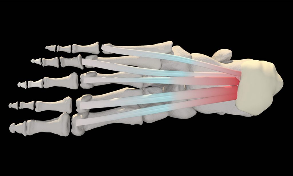 La fascitis plantar se genera por una inflamación en la fascia.