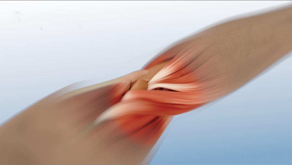 Codo con epicondilitis.